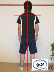 骨盤と仙骨のずれによる腰痛（ケガによるもの）の改善例