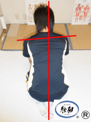 骨盤と仙骨のずれによる腰痛（ケガによるもの）の改善例